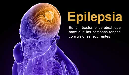 Epilepsia