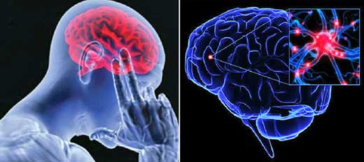 Accidente cerebrovascular