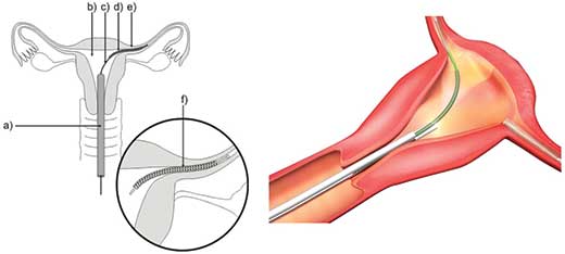 Essure