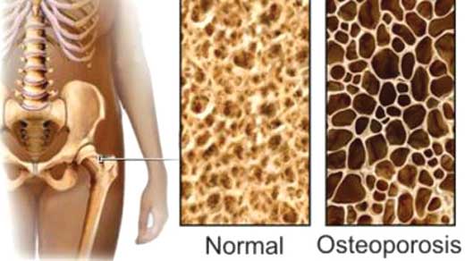 Osteoporosis